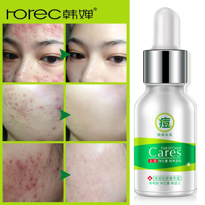 ROREC лечение акне набор кремов для лица + эссенция гиалуроновой кислоты анти