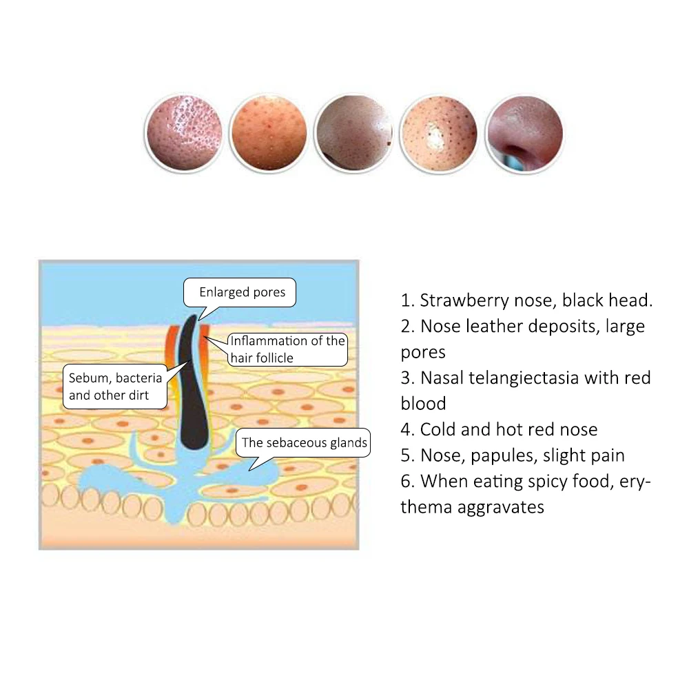 2 упаковки красным носом мазь от черных точек из черной Китайский травяной