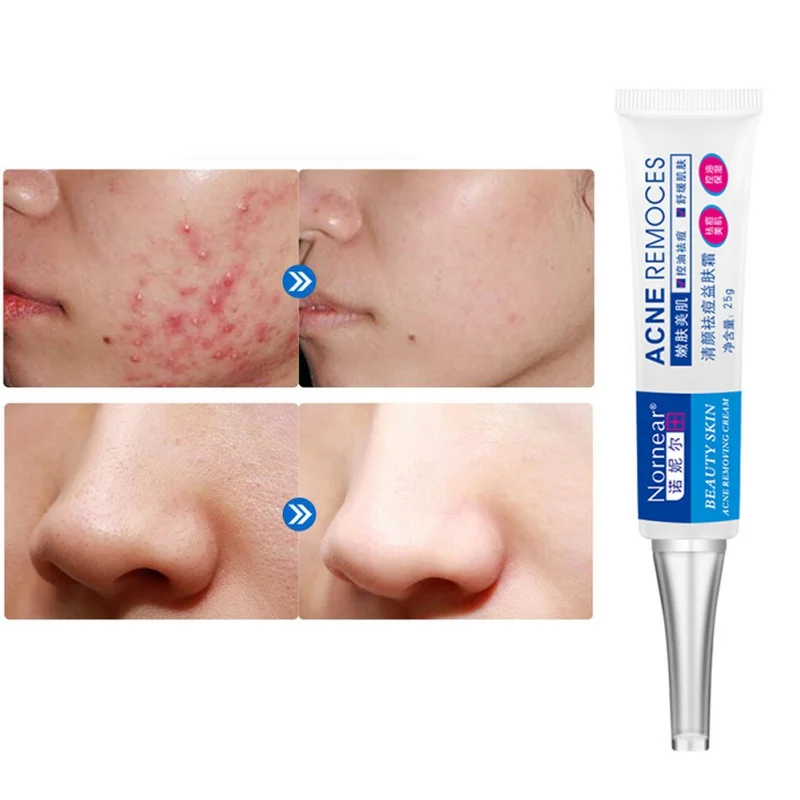 Крем от акне розовые угри возрастные пятна веснушки антибактериальный уменьшает