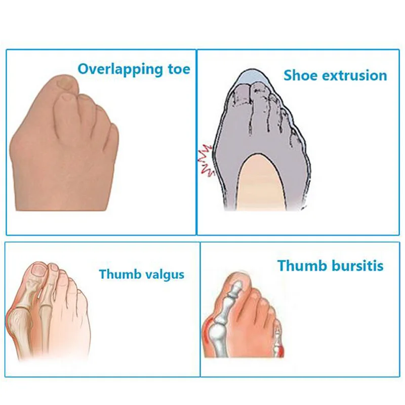 Demine Силиконовые ортопедические стельки для вальгусной деформации сепаратор
