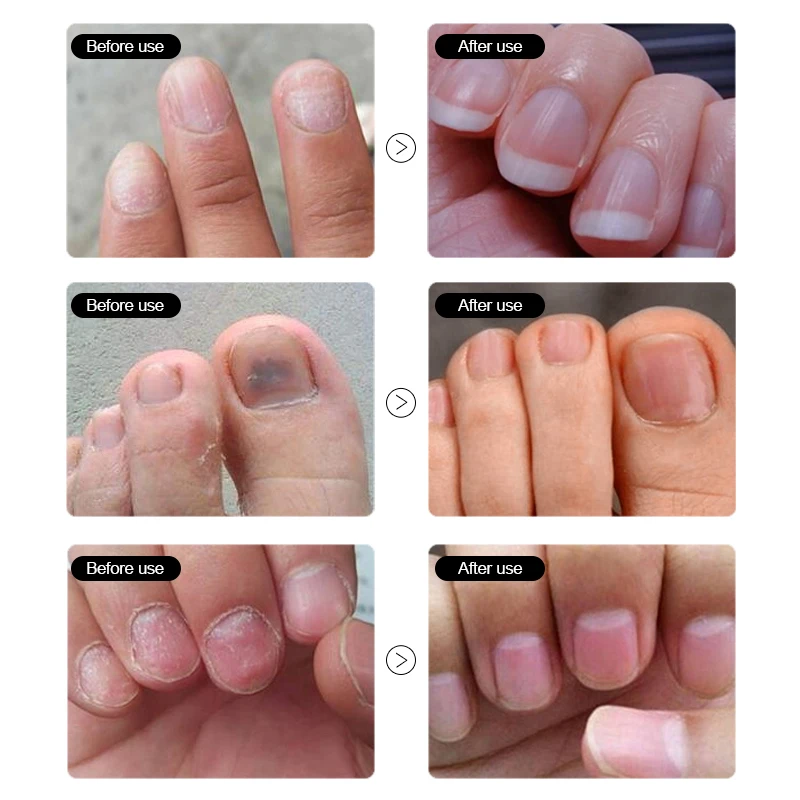 ROSALIND масло для ухода за ногтями грибка 1 шт. восстанавливает лак ногтей устраняет