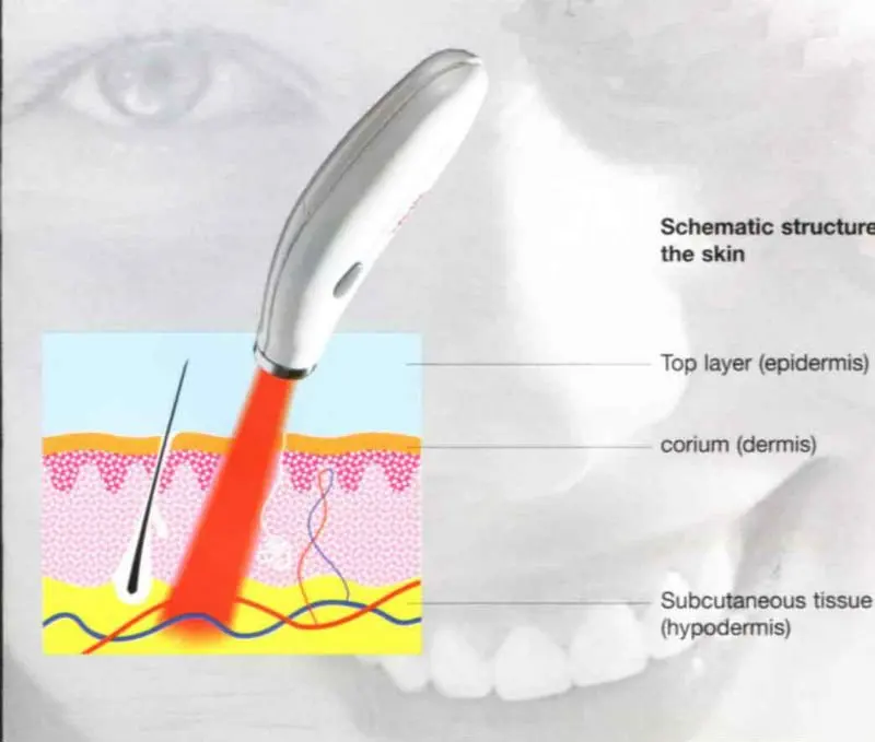 Handhold 635-670nm soft laser for Acne Treatment face care acne scar removal Skin |