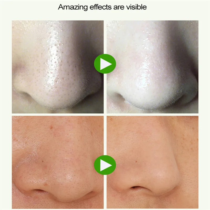 ROSALIND средство для удаления черных точек на носу глубокая очистка лица