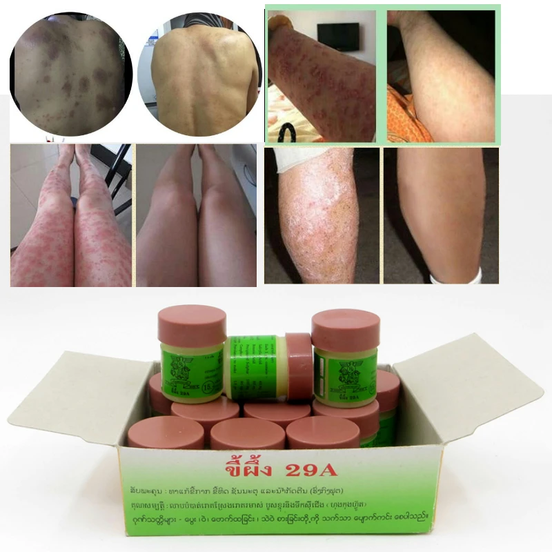 Китайская мазь Psoriasi Eczma Cream 2 шт. идеально подходит для проблем с все виды кожи 02 |