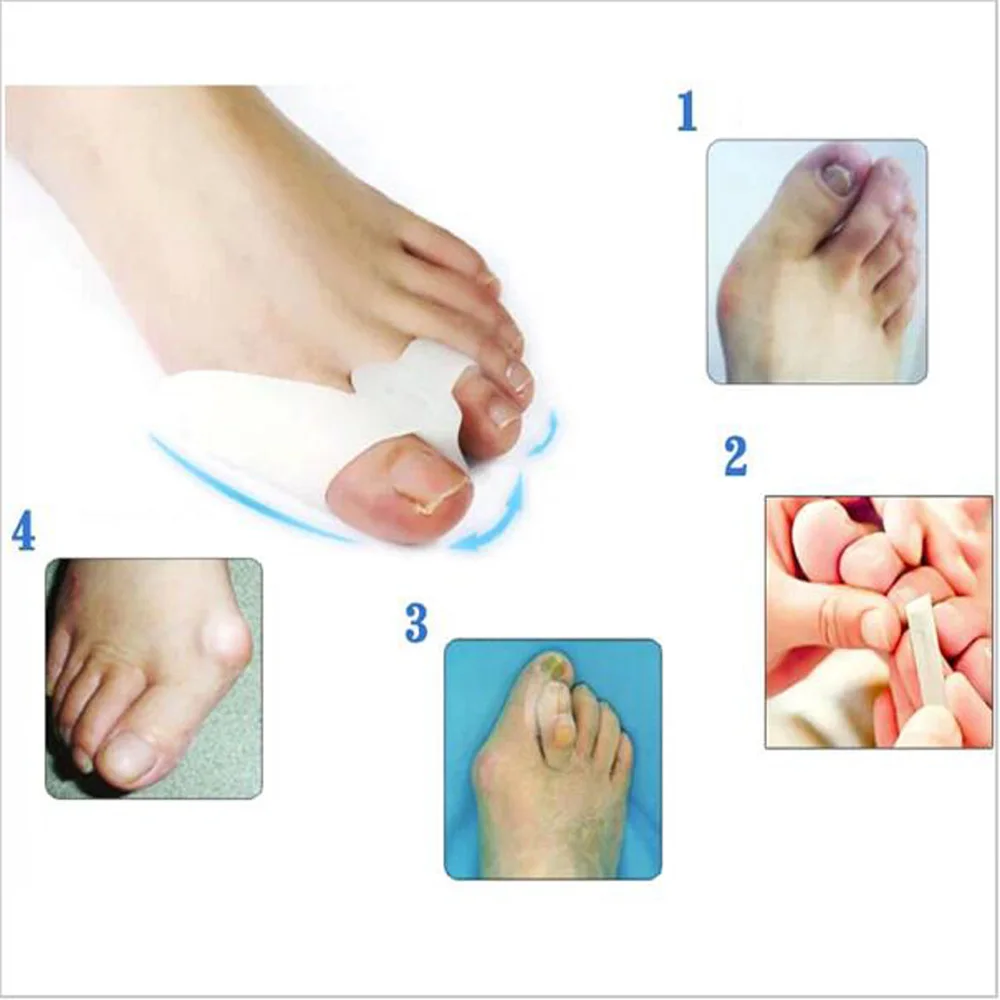 1 пара гель-бини-Защита силиконовый гель бюнион подтяжки большого пальца