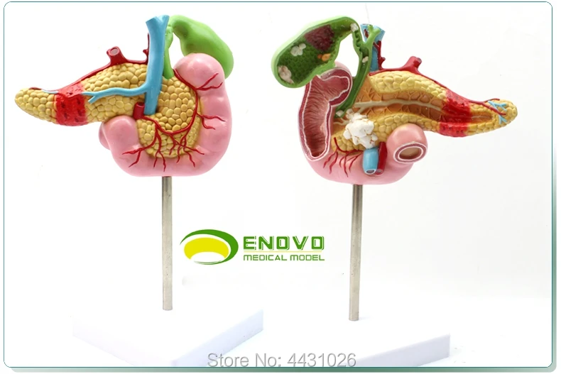 

ENOVO Surgical digestive system model of cholecystolithiasis in the pancreatic duodenal cholecystectomy in medical science