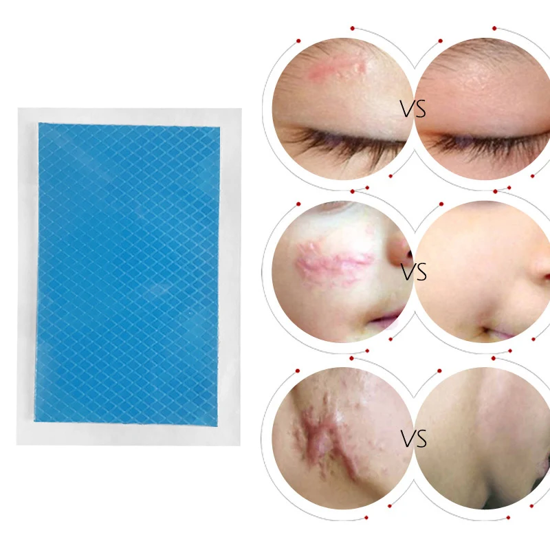 droppshiping Silicone Scar Therapy Sticker Remove Trauma Burn Silicon Patch Reusable Acne Gel Skin Repair MFJ99 | Красота и здоровье