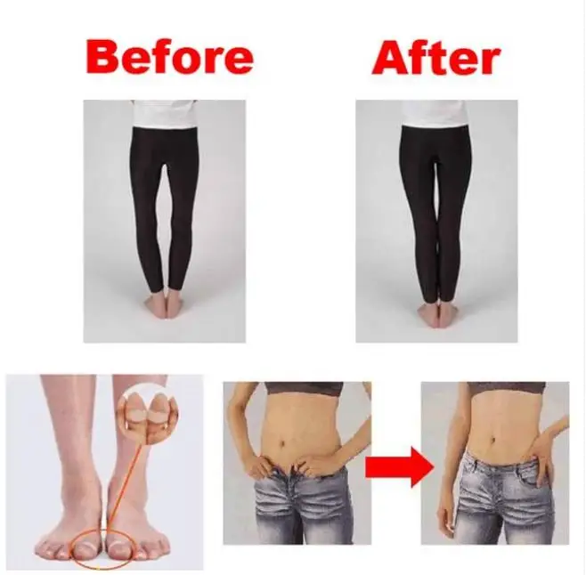10PCS/Lot Magnetic Toe Rings Therapy Slimming Products Fast Lose Weight Burn Fat Reduce Fats body Silicone Foot Massage | Красота и