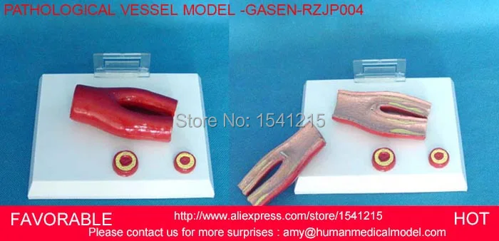 Модель гематологического сосуда модель атеросклероза человеческого сосудов