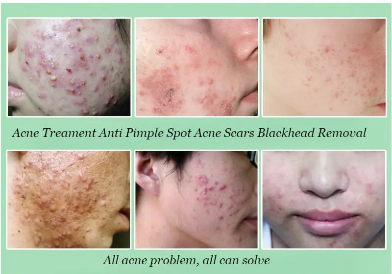 Dimollaure женьшень акне очищающий травяной крем уход за кожей удаление Комедон