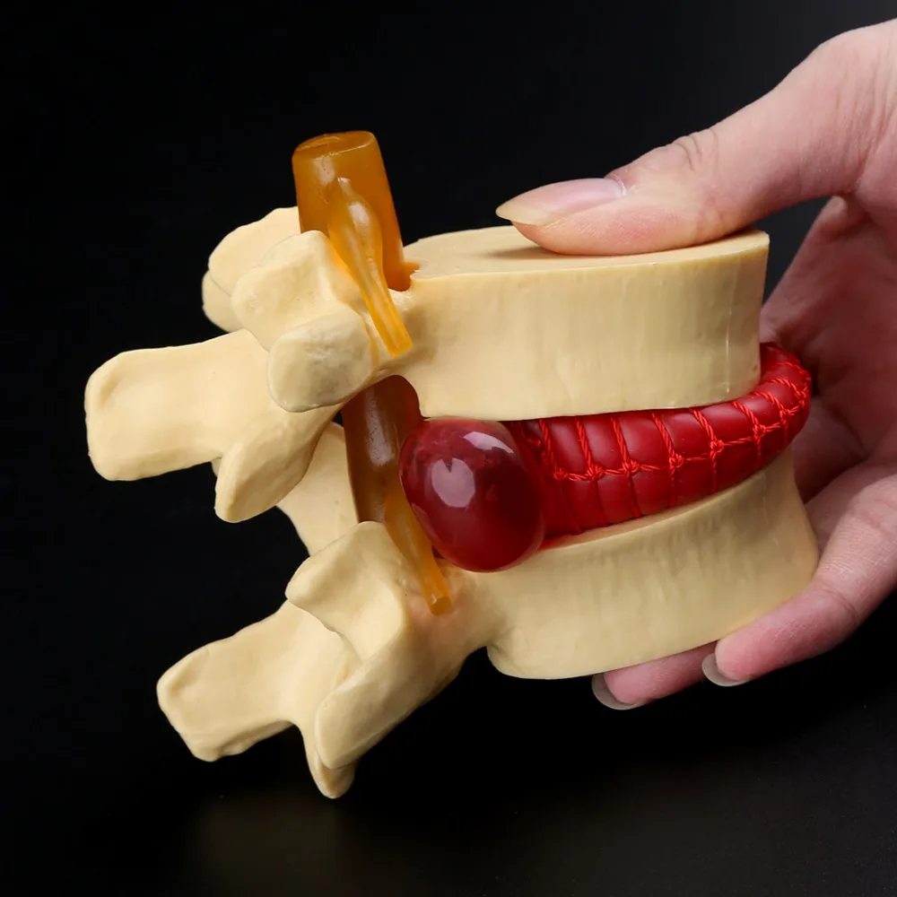 Anatomical Spine Lumbar Disc Herniation Anatomy Medical Model Teaching Tool School Supplies Instrume C26 | Канцтовары для офиса и