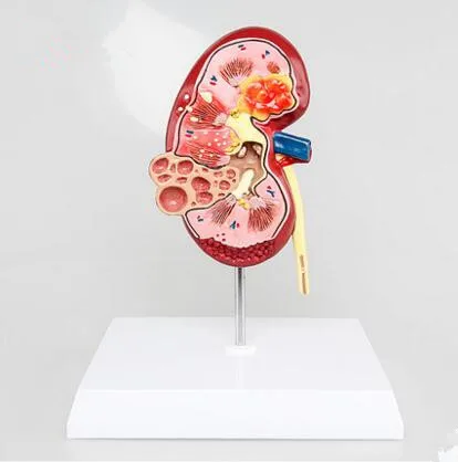 Медицинская модель развившейся почки с раком человека