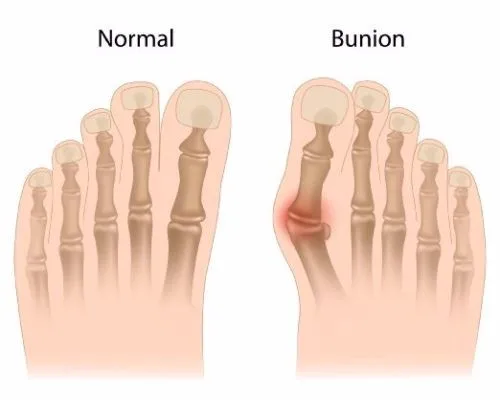 APTOCO Уход за ногами большой костный носок Bunion пальцевая шина от боли в ногах ортопедический вальгусный сепаратор для пальцев ног Педикюр ортопедические подтяжки