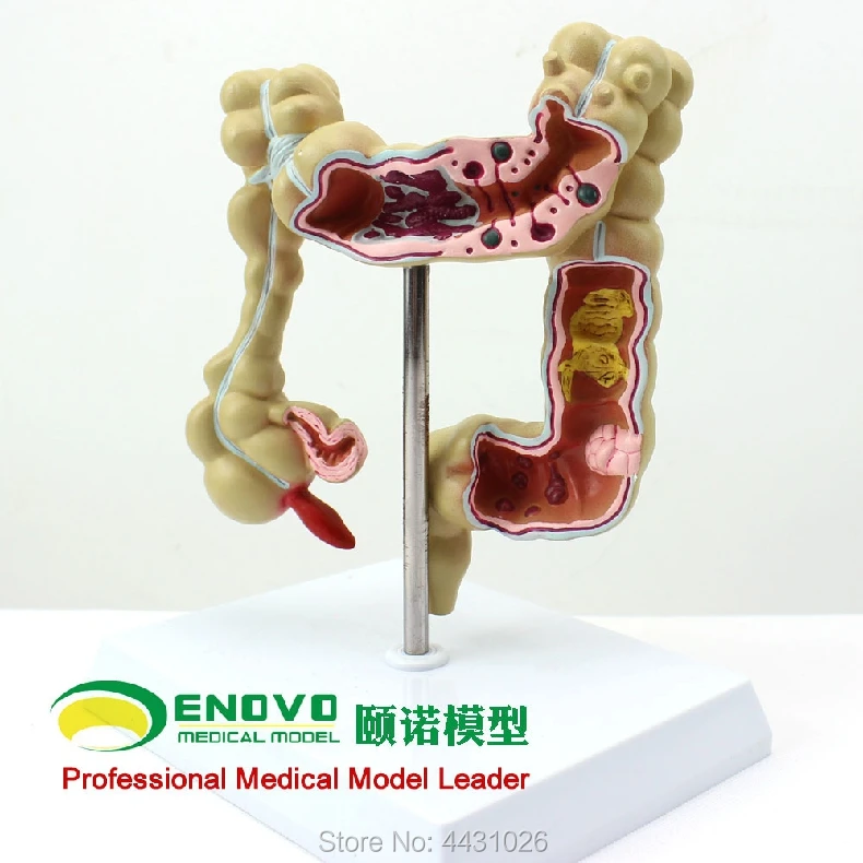 ENOVO Human Colon Disease Model Human Anatomy Of Large Intestine Model In Gastroenterology Department Of Anorectal Department