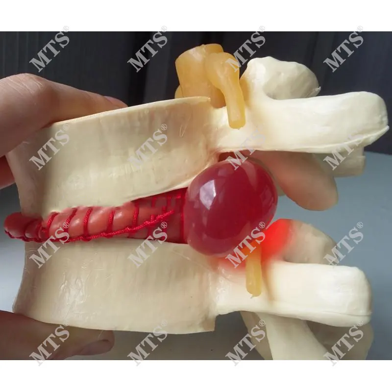 Человеческая планшетологическая герниация обучающая модель медицинский