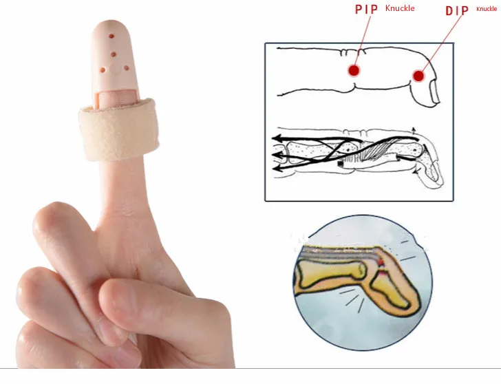 Hard Plastic Finger Splint Fracture Braces Tenosynovitis Ligament Damage Bone Care Fixing Sleeve | Красота и здоровье