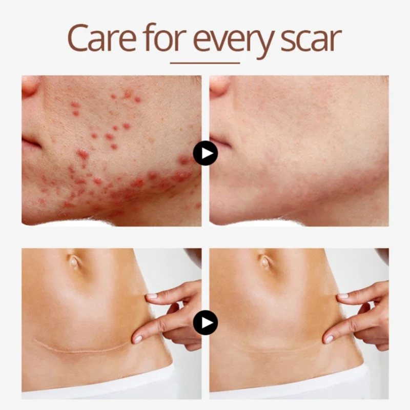 20 мл сглаживание кожи ремонт жидкости травма хирургия шрам тиснение шрамов уход