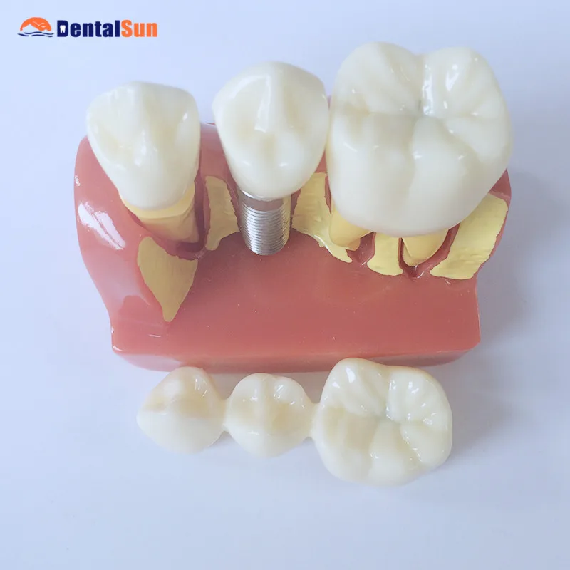 

4Times Implant Model/Dental Teeth Model HST-M3
