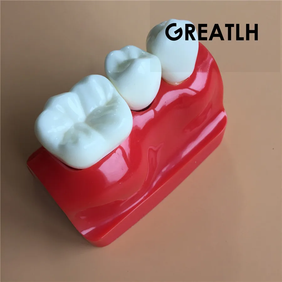 Стоматологическая обучающая модель имплантата анализ короны мост