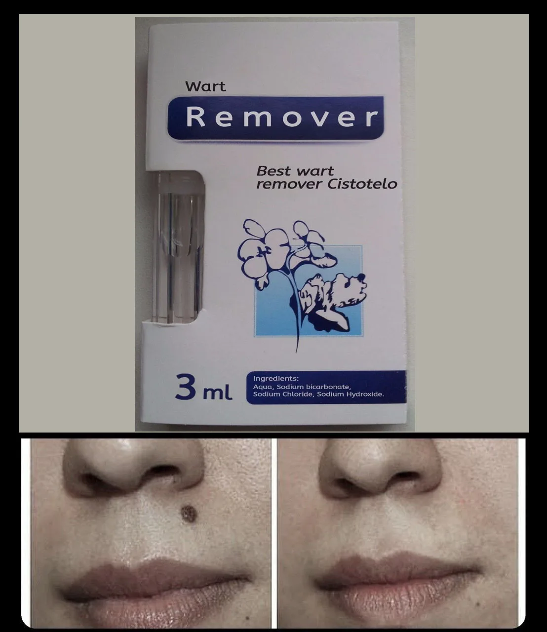 Новое избавление от бородавок быстро Удаление Pro лица генитальных естественное