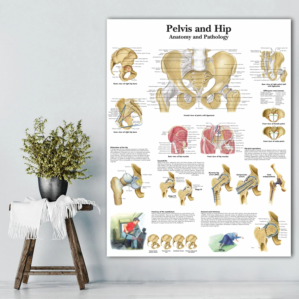 WANGART таз и бедра диаграмма анатомии патологии плакат печать на холсте настенные