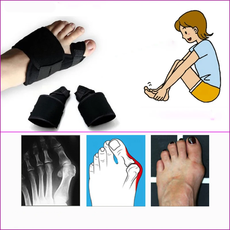 1 пара мягкие детали для измерения вальгусной деформации|foot care tool|care toolbunion orthotics |