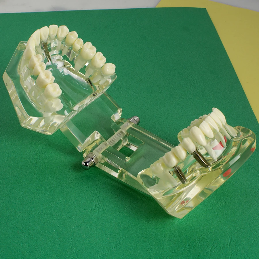 Зубной имплантант болезни зубов Модель зуб для медицинской науки