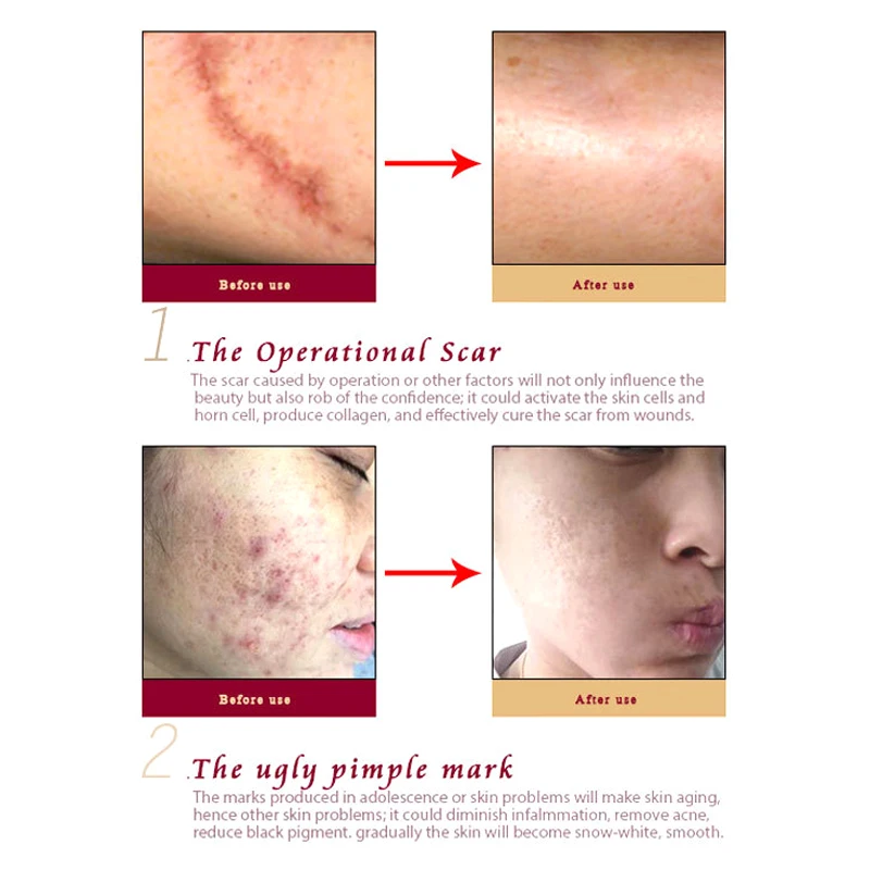 

Ginseng Extract Cream Scar Removal Facial Blackhead Acne Treatment Bleaching Ceam 30ml NShopping