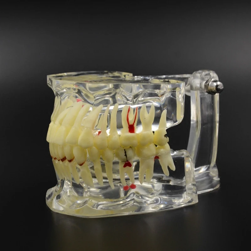 

High Quality Dental Implant Disease Tooth Pathological Extrusion Missing With impacted tooth dental pathological teeth implant