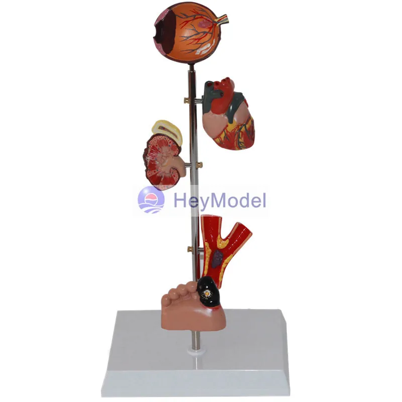 HeyModel человеческий диабет модель очага повреждений|Образовательное