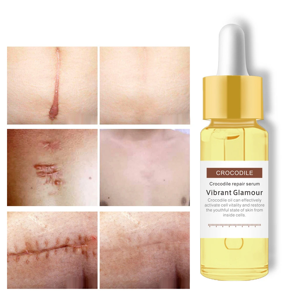 

Pregnant Women Crocodile Oil Stretch Mark Reducer Lightening Pigment Remove Skin Care Essential Cream Maternity Skin Care