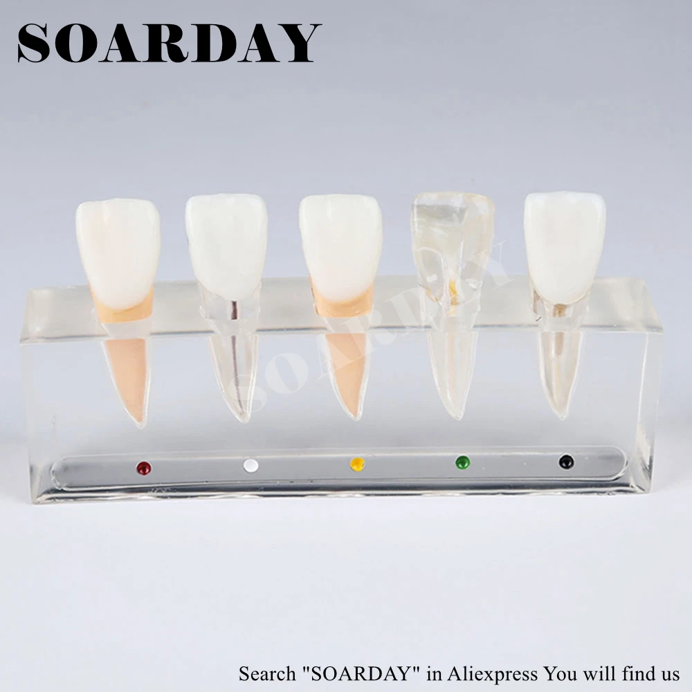 SOARDAY эндодонтическая реставрация модель обучения практики стоматолога пациента