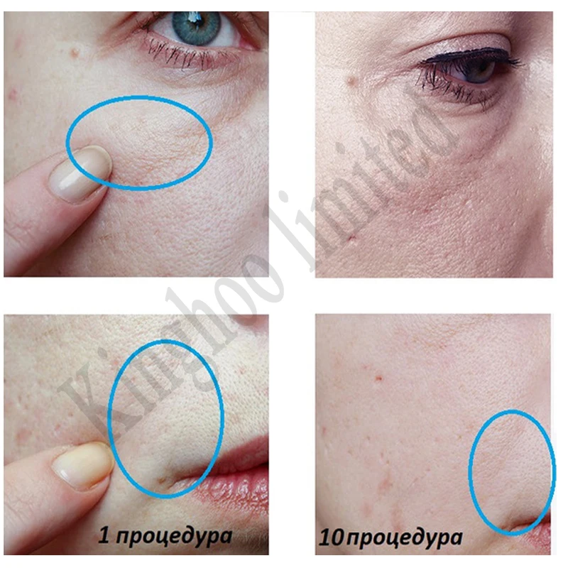 Нано-картриджи 3D/5D для dr pen MYM N2 M7 M5 50 шт. Антивозрастные микро-иглы Сменные