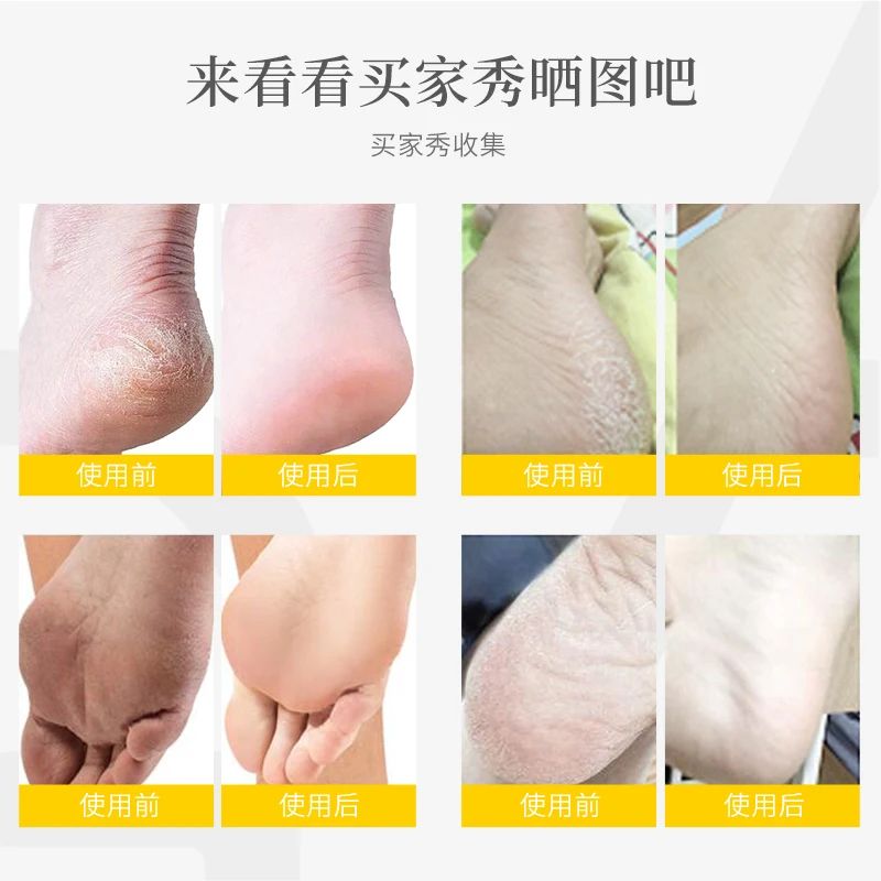 Бритва для удаления кукурузной кутикулы инструмент педикюра 10 лезвий ухода за