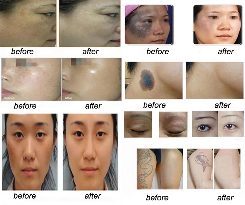 Новейшая Корейская машина для удаления веснушек q switched nd yag laser picoway laser Picosure Picosecond Laser для удаления татуировок