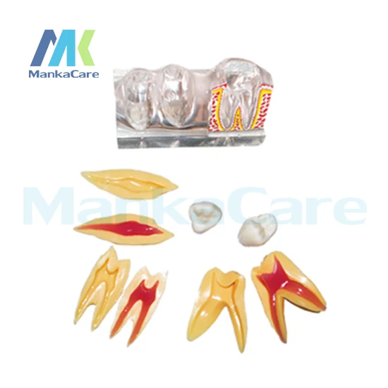 1 set Dental Implant Disease Teeth Model with Restoration Bridge Dentist for Medical Science Teaching 4 times teeth model