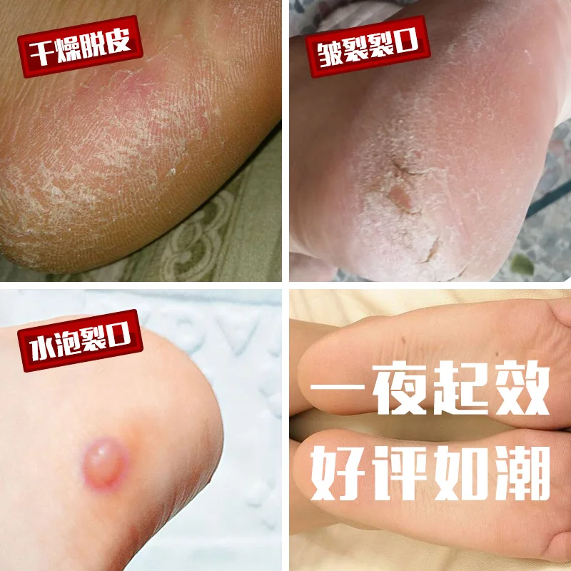 Женские носки с эффектом трещин силиконовые накладки на пятку и пятку|Брекеты