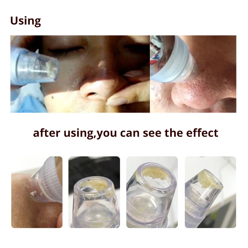 Blackhead Remover Skin Care Pore Vacuum Acne Pimple Removal Suction Tool Facial Diamond Dermabrasion Machine Face Clean |