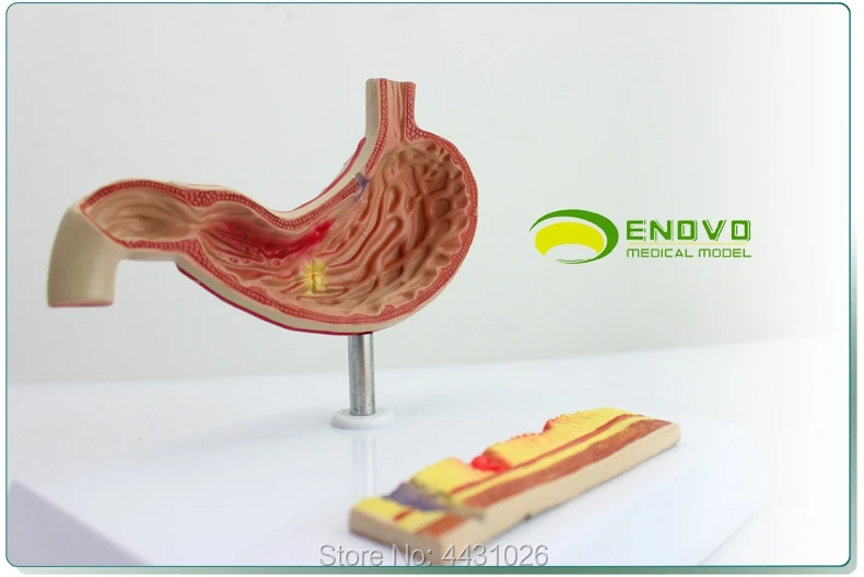 

Model of digestive system of digestive system of gastric ulcer model