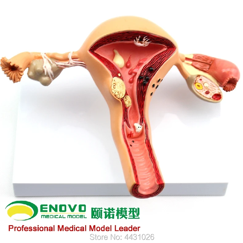 ENOVO Model of gynecological and obstetrical disease model of gynecology and obstetrics gynecology