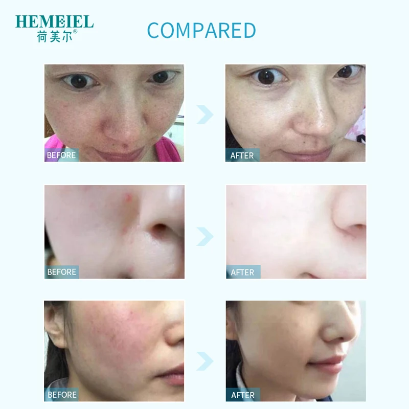 HEMEIEL Fast Repair Маска для лица Античувствительная Улучшить покраснение Сухость