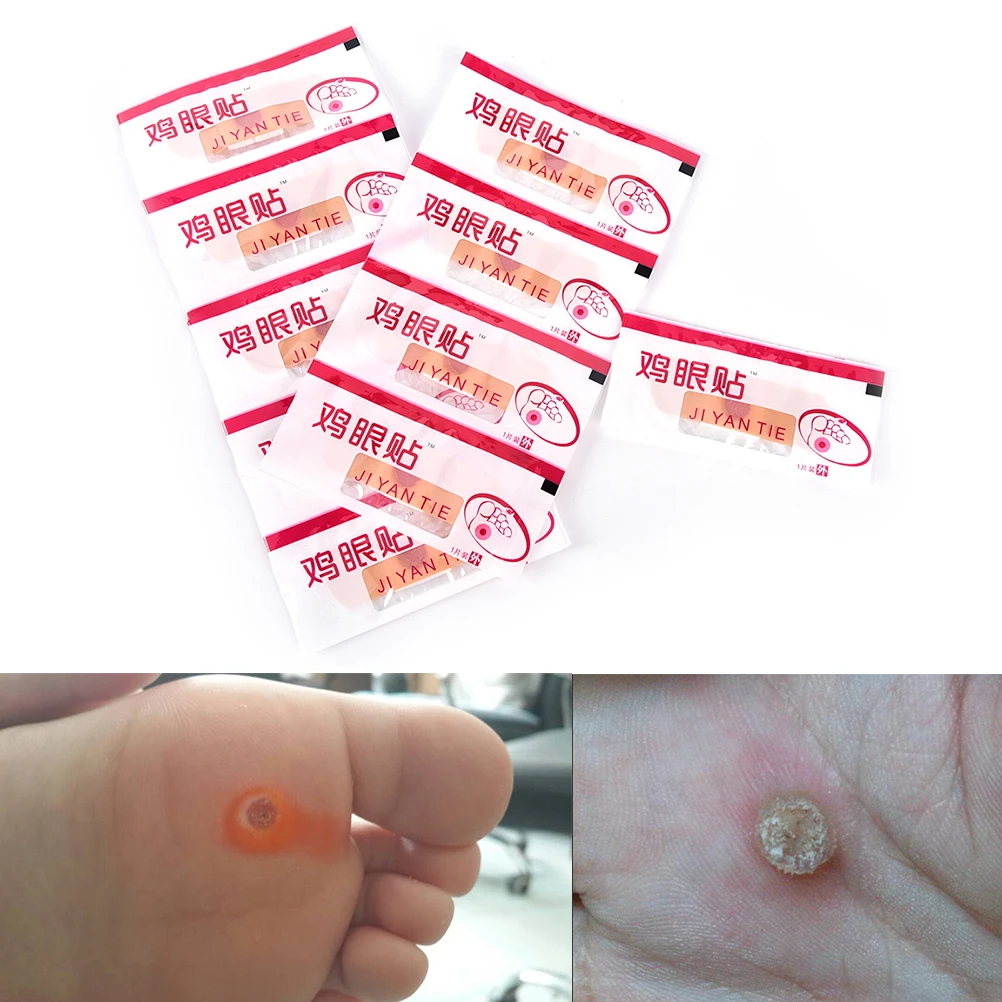 10 шт. удаление кукурузы для рук омертвевшей кожи Pedi Cure Care Китайская традиционная