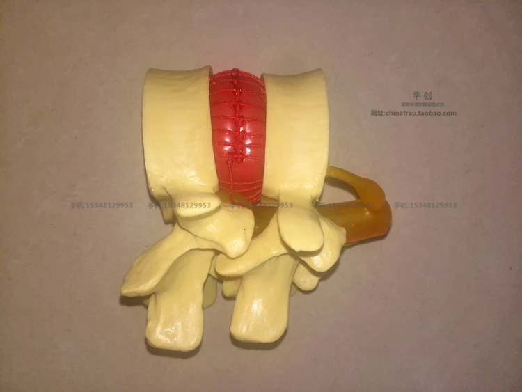 Медицинский Поясничный позвонка модель поражения нормальном состоянии CMAM VERTEBRA12