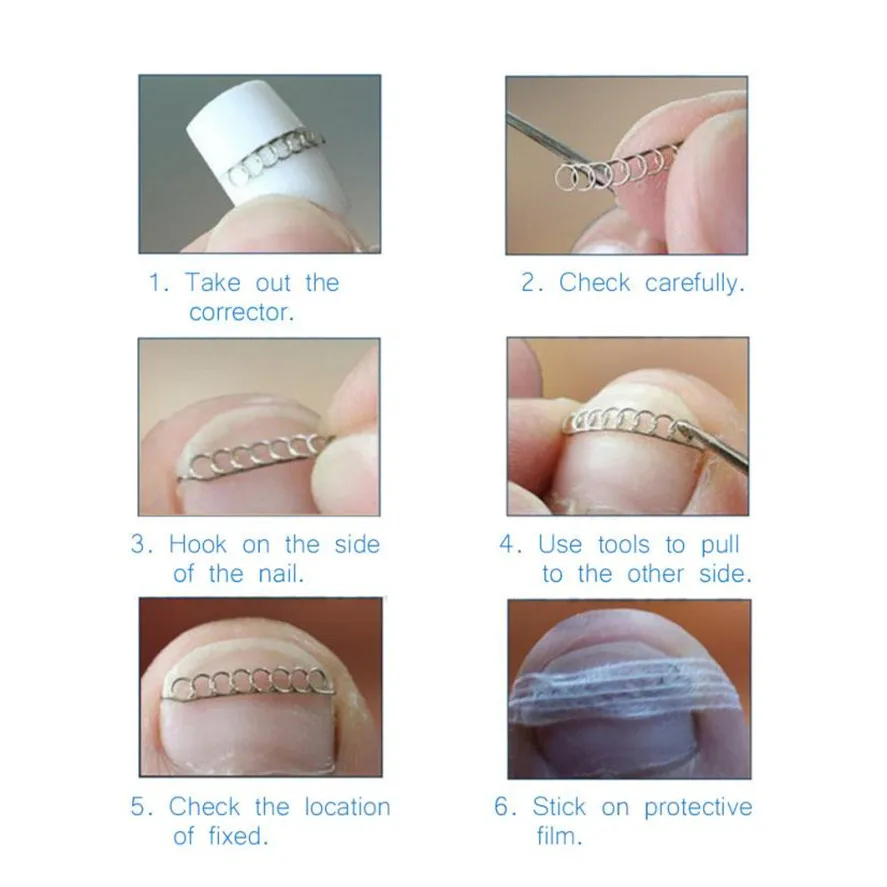 New Foot Care Tool Stainless Steel 6pcs Ingrown Toe Nail Correction Pedicure Wire Fixer Paronychia Recover | Красота и здоровье