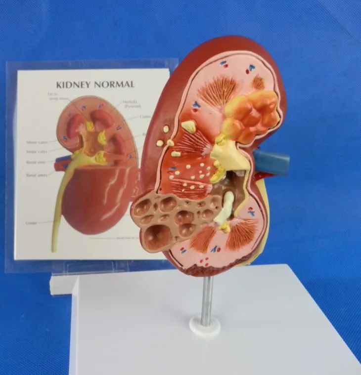 Медицинская модель развившейся почки с раком человека