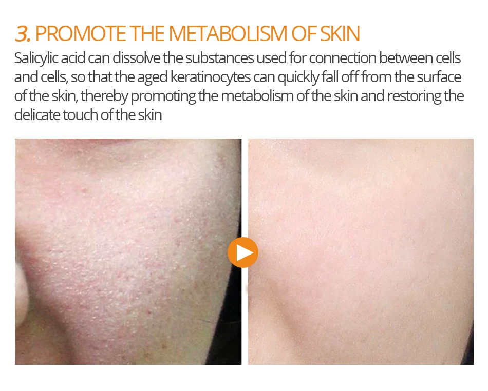 VIBRANT GLAMOUR Salicylic Acid Condensation Cream удалить маска для лица против прыщей масло управление уход за кожей лечение пигментации корректор 100 г