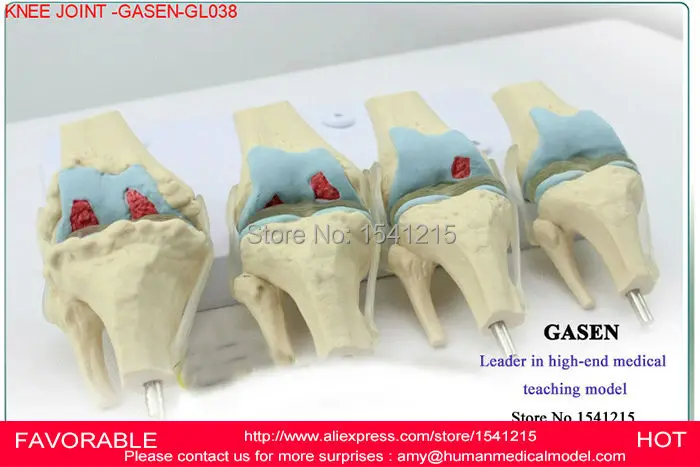 Модель коленного сустава модель человеческого скелета артропатия патология