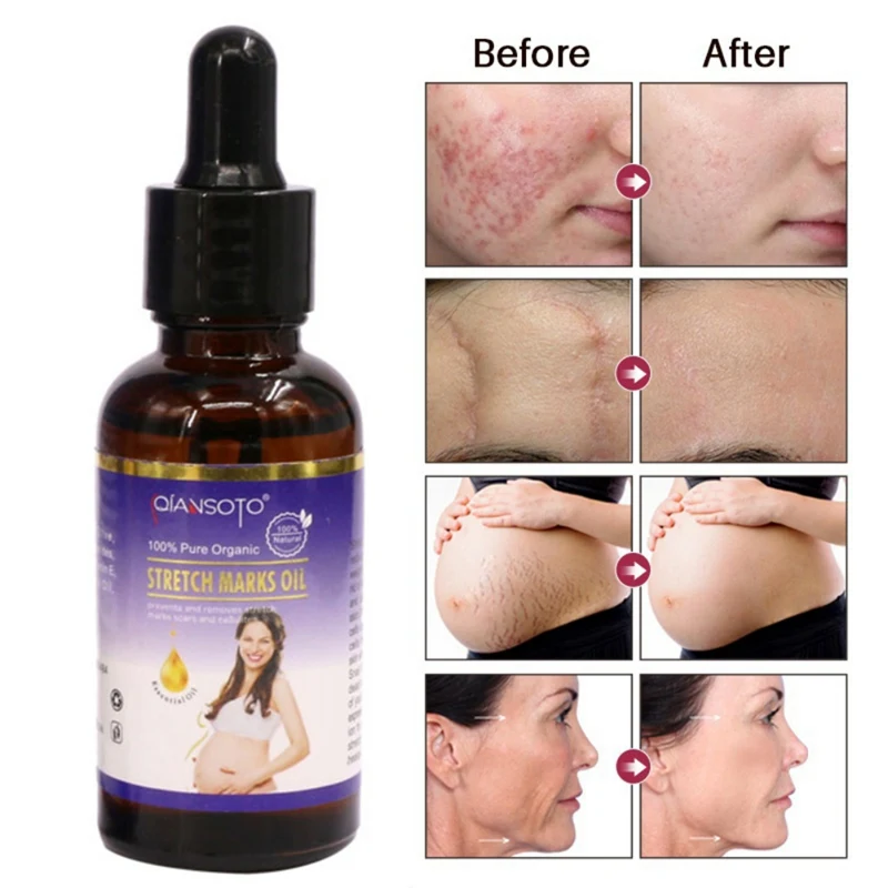 Крем растяжка для восстановления тела Удаления растяжек эфирное - Цена: 357,76 руб.