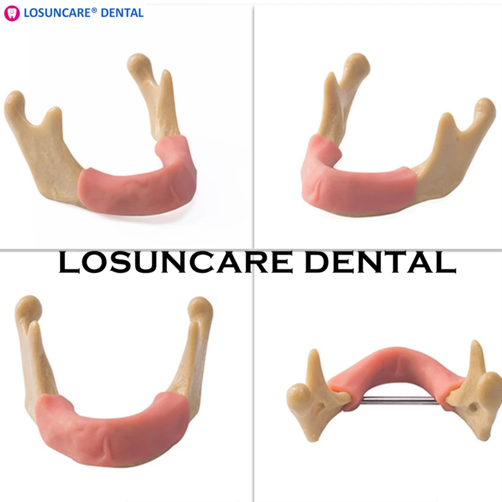 LOSUNCARE зубная модель имплантации тренировочный инструмент с мягкой тканью |
