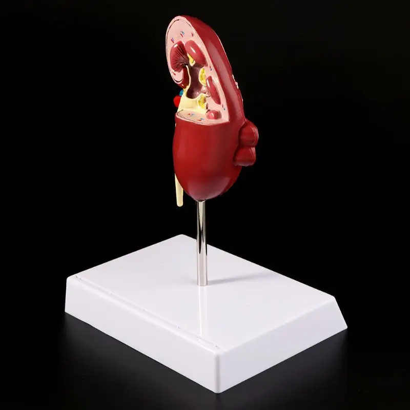 

Kidney Diseased Model Anatomical Anatomy Diseased Pathological Stone Organ Teaching Supplies L29K